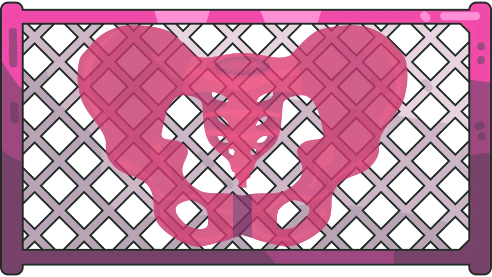 A pelvis covered in surgical mesh, all in pink, representing a vaginal or pelvic mesh implant.